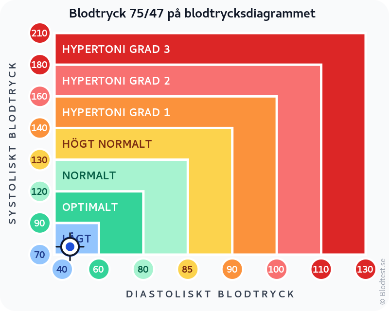 Blodtryck 75 över 47 – lågt blodtryck (hypotoni) – klassificeringsdiagram med systoliskt och diastoliskt värde